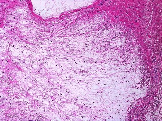 Bland spindled to stellate fibroblastic cells in a myxoid background. Note the surrounding septa composed of fibrous tissue. H&E stain, 200X magnification