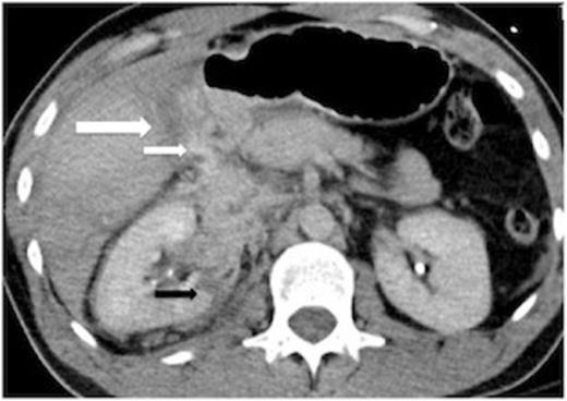 Preoperative CT scan showing a liver laceration (large white arrow) and IV contrast extravasation in proximity to the laceration (small white arrow). The normally fluid filled gallbladder is not well seen here. The right kidney is also lacerated (black arrow). There is not a large haemoperitoneum.