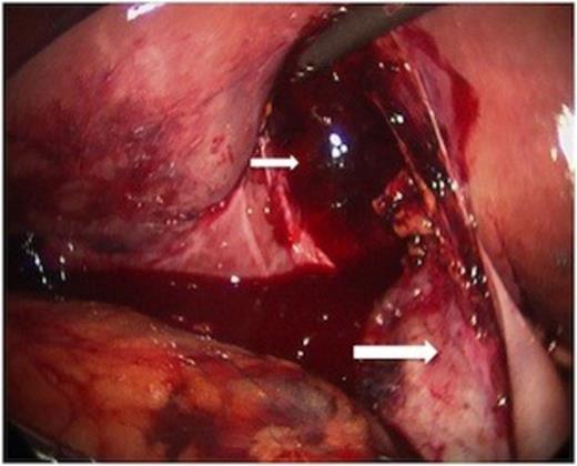 At laparoscopy, the gallbladder (large white arrow) was found partially avulsed from the gallbladder fossa (small white arrow).