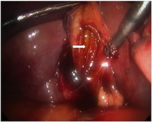The body of the gallbladder was perforated on its inferior surface (arrow).