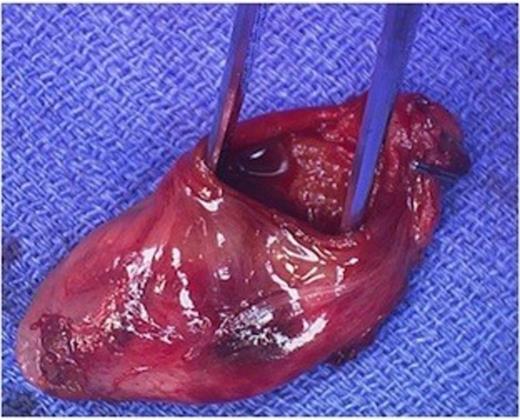 The gallbladder was perforated along its body.