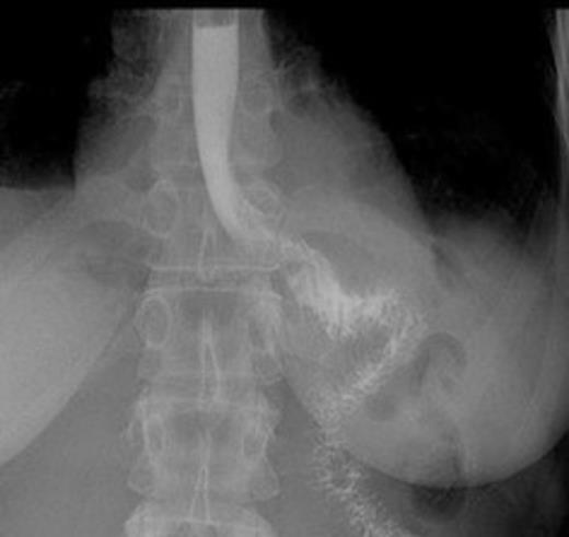 Postoperative contrast swallow