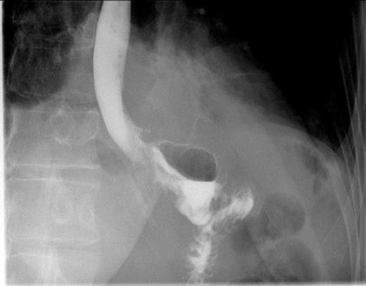 Postoperative contrast swallow