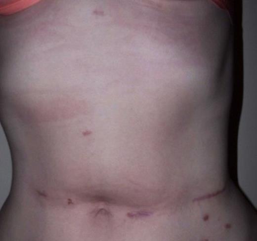 Postoperative picture of wound