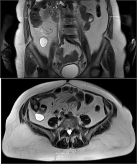 MRI of the abdomen. Axial and coronal T2-weighted TSE images showed the presence of a fluid-filled cystic lesion in the retrocaecl adipose tissue.