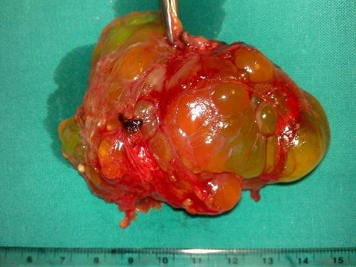 Fluid-filled cystic lymphangioma with polycyclic edge and internal septa (intraoperative specimen)