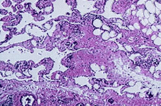 Numerous dilated lymphatic spaces, sometimes filled with lymph and covered by endothelial cells