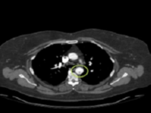 A cross sectional CT-angiogram showing the mobile aortic plaque in the descending thoracic aorta. This image is taken prior to intervention