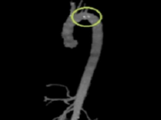 CTA reconstruction highlighting the floating plaques distal to the Left Subclavian artery takeoff