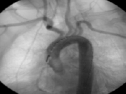 Diagnostic aortic angiography demonstrating darkening distal to the left subclavian possibly representing plaque. Image prior to stent deployment