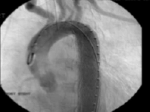 Fig 4: Post endovascular stenting angiography showing appropriate seal without leaks or extravasation of contrast