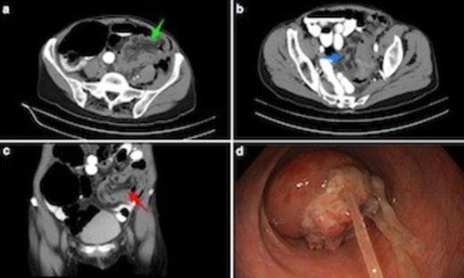 (a) Axial CT scan shows sigmoidorectal intussusception. Note bowel wall thickening. Low attenuation mesenteric tissue is drawn into intussusceptum, with associated caecal dilatation. (b) Axial view through mid-pelvis showing gas between bowel wall of intussusceptum and intussucipiens (i.e. sigmoid colon and rectum: this does not represent intramural gas). (c) Coronal view demonstrating mesenteric vasculature in the intussusceptum. (d) Endoscopic view from mid rectum of tumour intussusception. The underlying lesion was an apple core T3N1 adenocarcinoma of the mid-sigmoid. Note tumour mucus.