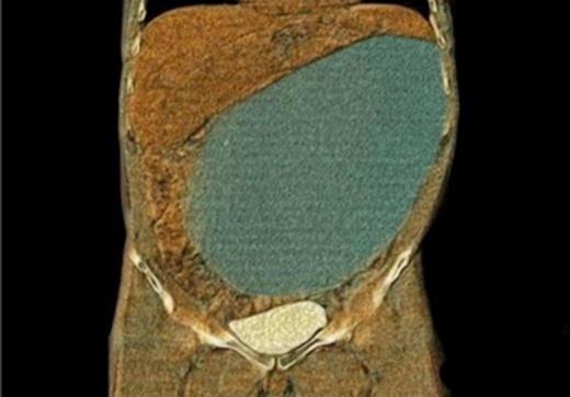 CT scan showing a large homogeneous cystic mass (34x17x25cm)