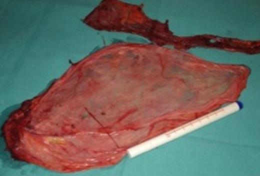 Macroscopic specimen showing mesenteric cystic wall following aspiration of the fluid