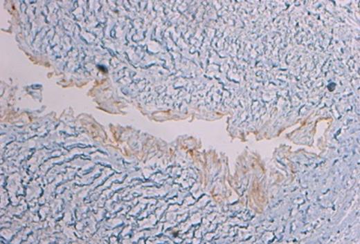 Histology showing immunohistochemistry by marker D2-40 identifying the lymphatic endothelium