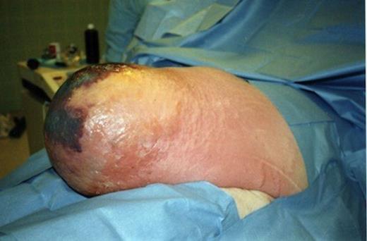 Massive incisional hernia with necrotising fasciitis of the overlying soft tissues