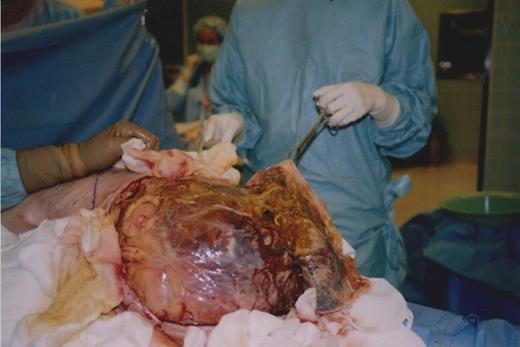 Necrotic small bowel with perforation and faecal contamination within hernial sac