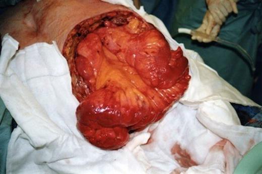 After debridement of necrotic abdominal wall and small bowel resection