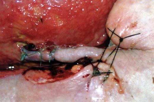 The pedicle flap overlying fistula closure
