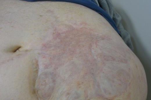 Repair at long-term follow-up