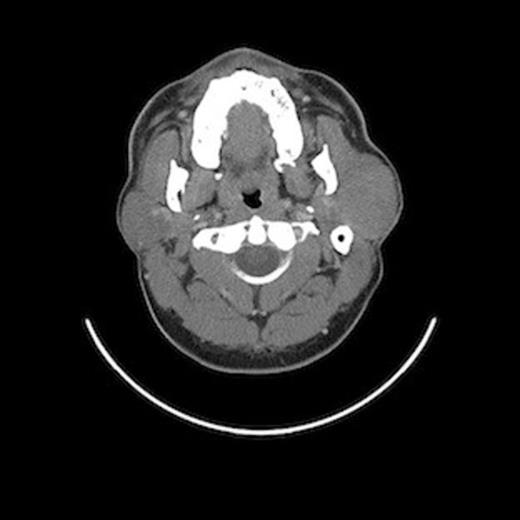 An Axial CT scan demonstrating diffuse left parotid mass.