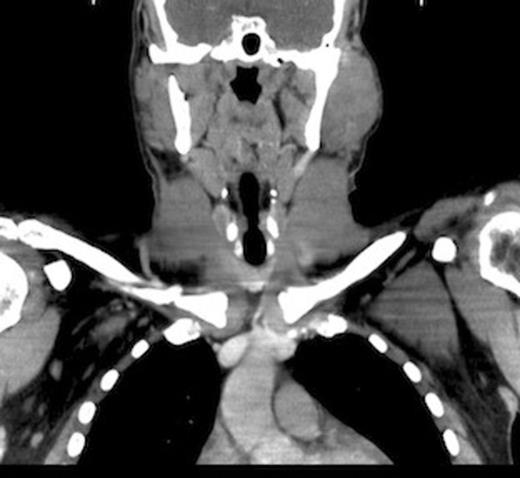A Coronal section on CT scan demonstrating left parotid mass.