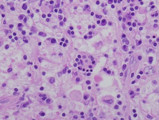Left parotidectomy specimen showing histiocytes with marked emperiopolesis of leukocytes. Hematoxylin and Eosin stain of Paraffin embedded surgically removed parotid mass tissue viewed at 600x.