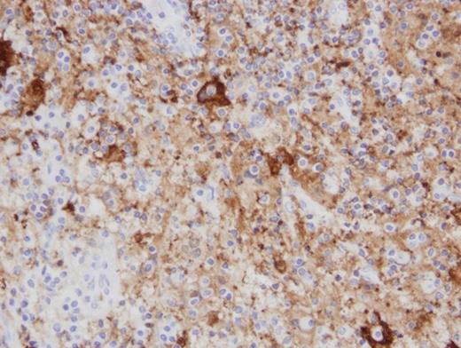 An Immunohistochemistry stain shows s100 protein deposition within the histiocytes. S100 immunohistochemistry stain of Paraffin embedded surgically removed parotid mass tissue viewed at 400x.