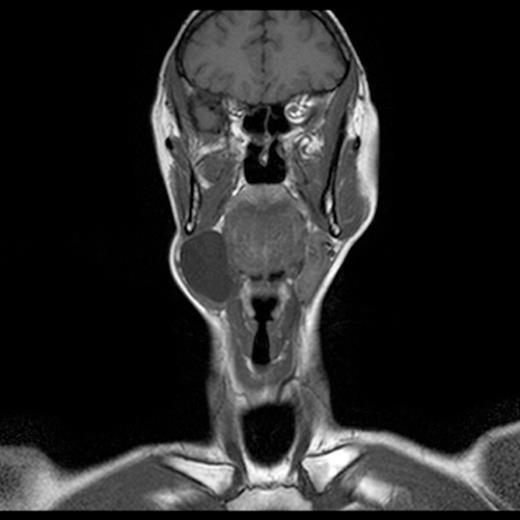 MRI scan showing cystic lesion within lateral neck