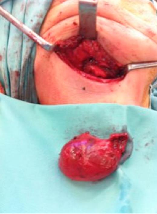 Intraoperative photograph of the excised submandibular gland mucocele