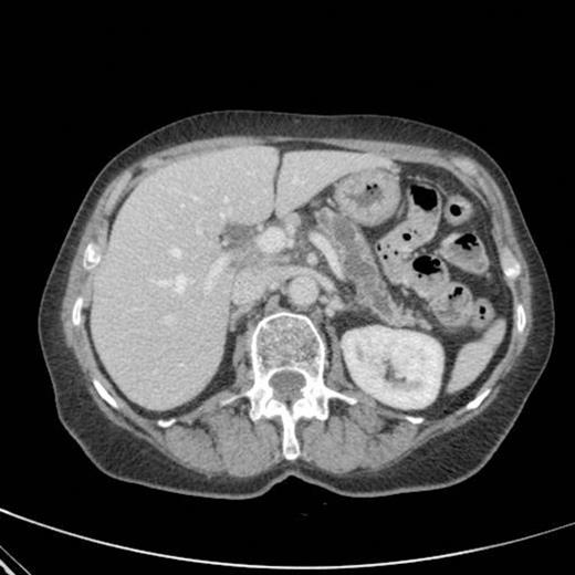 CT scan showing marked dilatation and tortuosity of the main pancreatic duct (12-13mm at the head) with atrophy of the body and tail