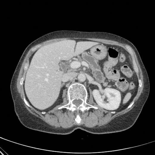 CT scan showing pancreatic duct dilatation to 15 mm with side branch dilatation in uncinate process and atrophic pancreas