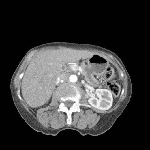 CT scan showing gross dilatation of main pancreatic duct