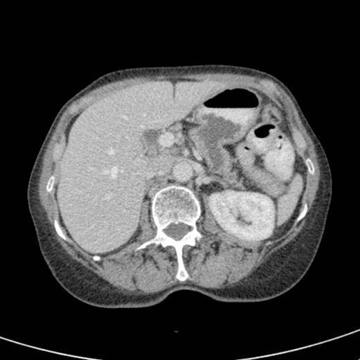 CT scan showing persistent gastro pancreatic fistula