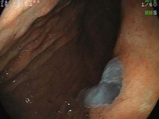 Upper GI endoscopy showing gastric opening of the fistula