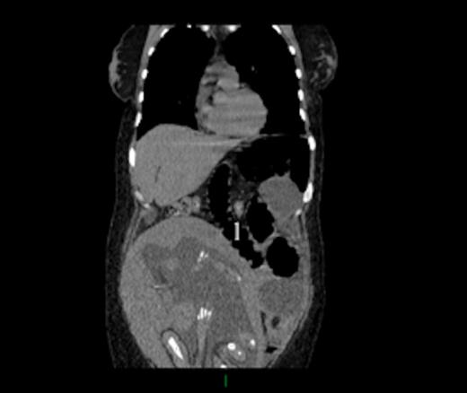 CT scan showing volvulus of the jejunojejunal anastomosis