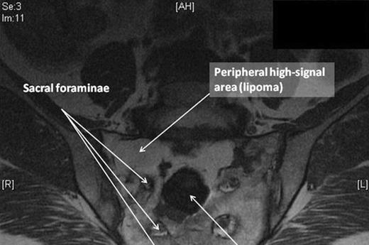 MRI
