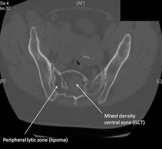 CT Scan