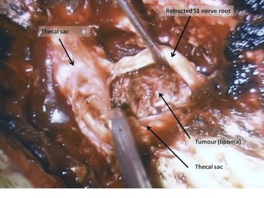 Intra-operative picture