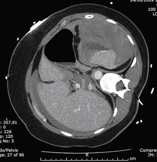 Computed Tomography (CT) of abdomen and pelvis scan demonstrating large haemoperitoneum with a large peri-splenic haematoma