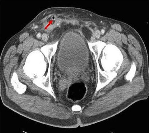Axial CT showing luminal air of appendix segment in the scotum (arrow)