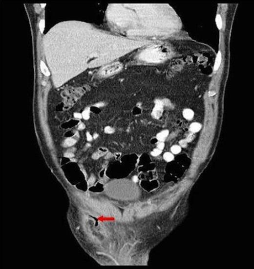 Coronal CT showing descent of appendix segment into scrotum and associated fat stranding