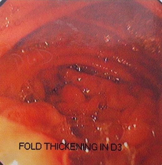 Upper GI Endoscopy
