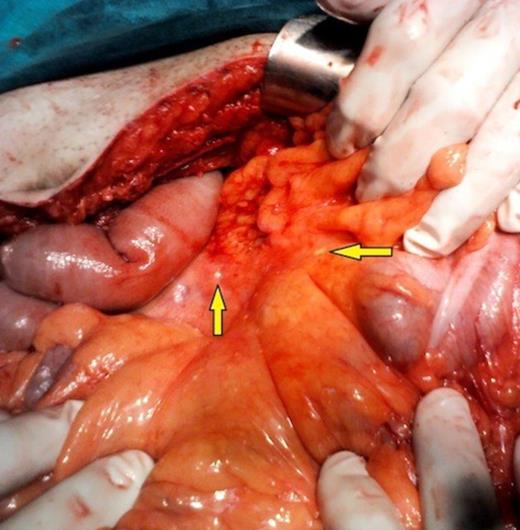 Peritoneal seedlings
