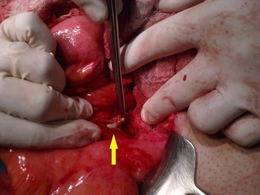 Primary at duodenum