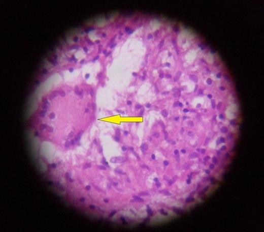 HPE shows langhans cells