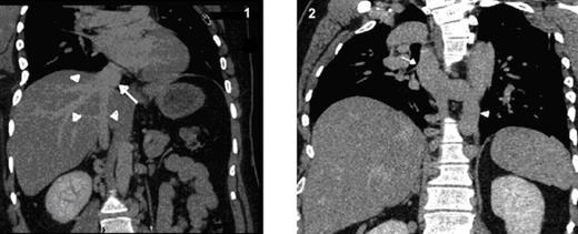 Coronal MPR CT image shows hepatic veins (arrow heads) seen draining into the intra-hepatic segment of IVC (arrow)
