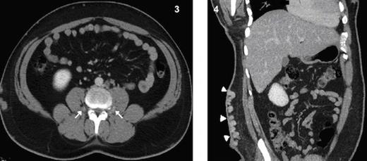Coronal MPR CT image shows grossly dilated azygous vein (arrow) and hemiazygous vein (arrow heads)