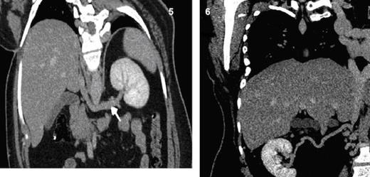 Coronal MPR CT image shows a long left renal vein seen draining into the intra-hepatic segment of IVC. Fig. 6 Coronal MPR CT image shows a right renal collateral vessel draining into hypoplastic segment of IVC.