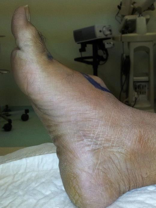 Dorsum of the right foot showing a pulsatile mass suggestive of a dorsalis pedis artery aneurysm